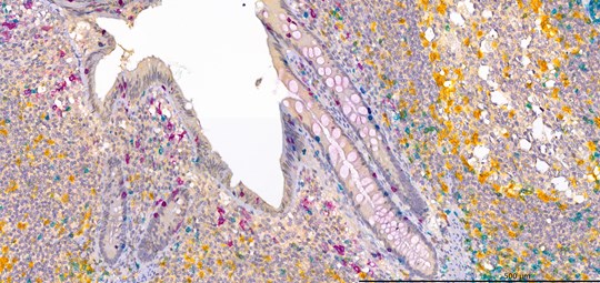 Immunohistochemical staining of paraffin-embedded Human Appendix triple stained for
PD1 (Yellow) - CD8 (Teal) - CD103 (Purple)