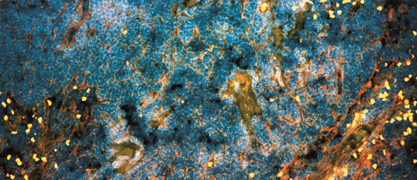 Microscopic image of prostate cancer cells that metastasized to the lymph node of the patient.