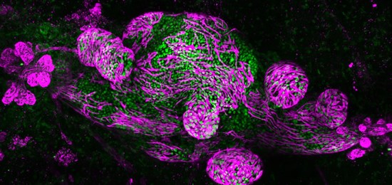 Microscopic image of  human Ductal Carcinoma In Situ (Green) tumor cells growing inside the mammary duct