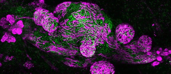 Microscopic image of  human Ductal Carcinoma In Situ (Green) tumor cells growing inside the mammary duct