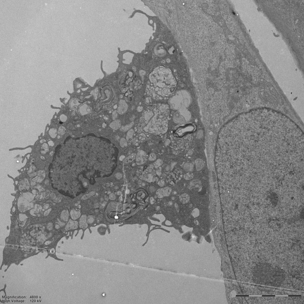 <p>A microscopy image showing the interaction between a fat-laden macrophage (left) and a glioblastoma cell (right). Myelin is visible (the round, layered structures) alongside visible lipid droplets.</p>