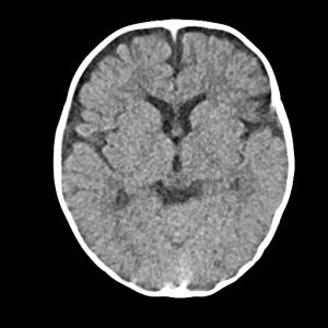 Clinicians Should Reduce CT Use In Children