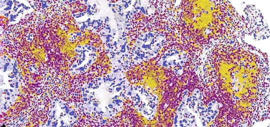 Tumor tissue resembles a geographic map with different areas.