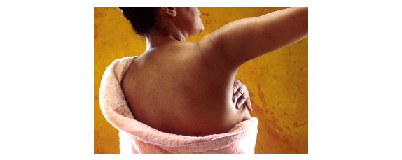 BRCA1 Breast Cancer