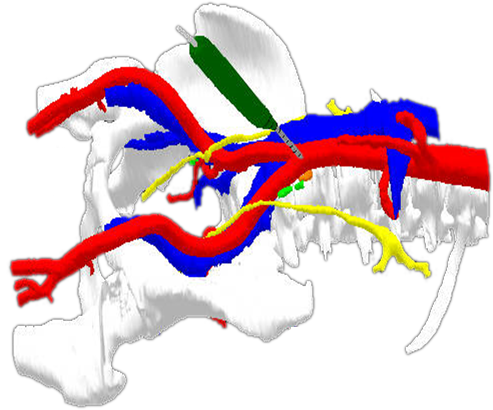 Targeted Abdominal Lymph Node Dissections Randomized For Surgical Navigation