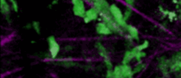 Intravital microscopy movie of migratory breast cancer cells