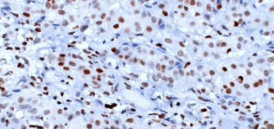 EZH2 overexpression in BAP1-deficient Mesothelioma