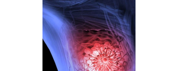 Breast Cancer
