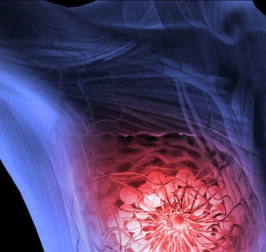 Breast Cancer