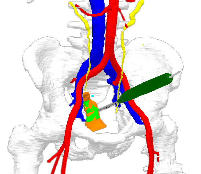 Real Time In Vivo Sensor Tracking Of Rectal Tumours During Colorectal Cancer Surgery
