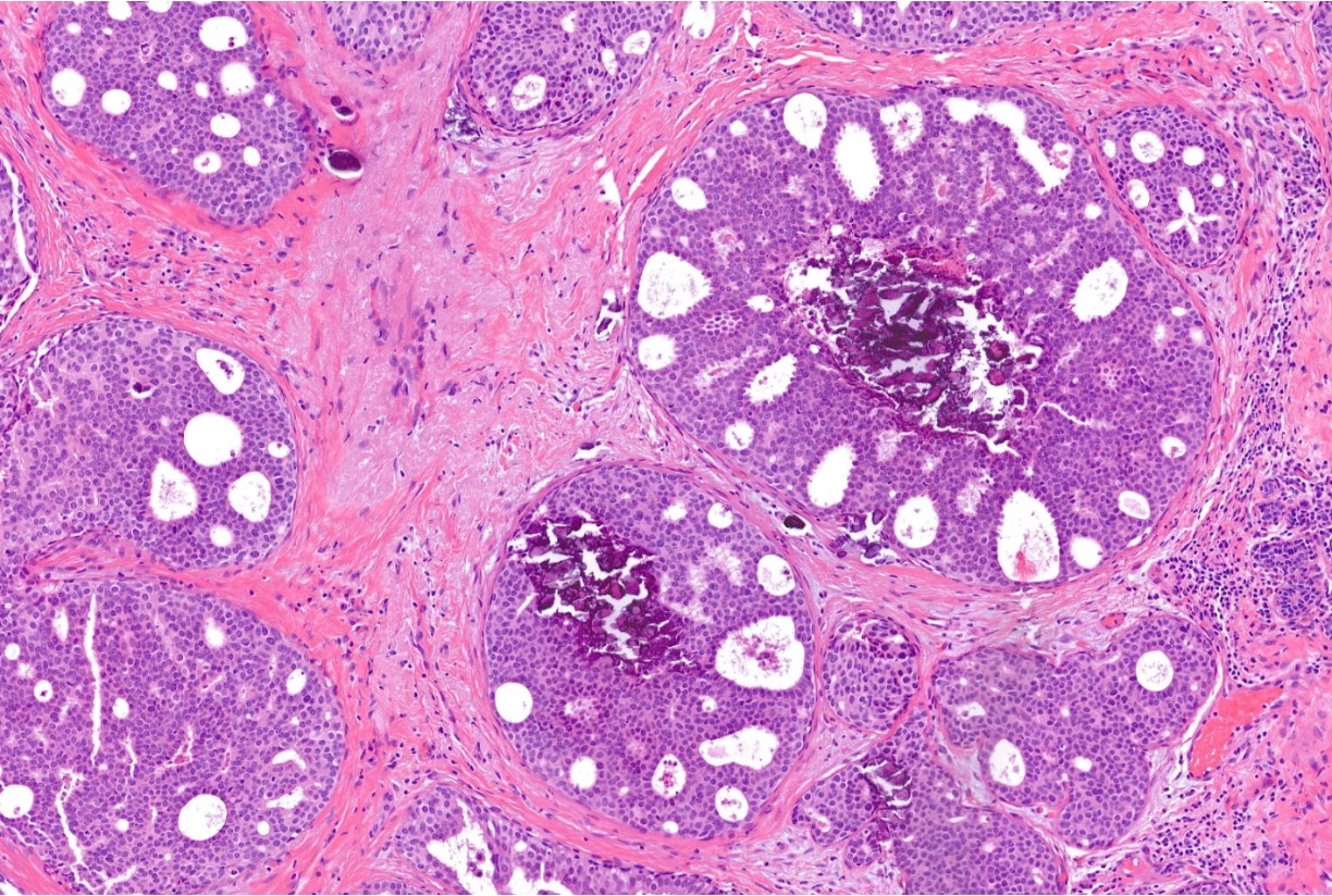 Example DCIS 1