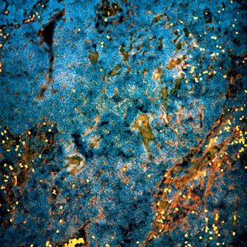 Metastatic Prostate Cancer Hijacks DNA Program For Embryonic Development