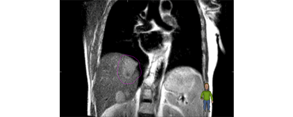 3D MRI