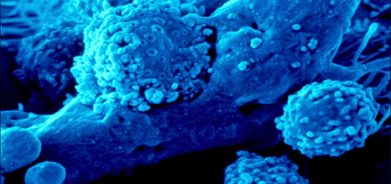 Electron microscopic image of T cells attacking a tumor cell