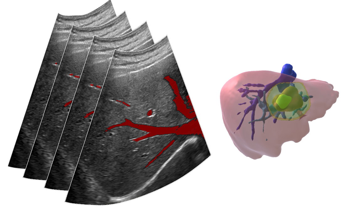 Laparoscope Tracking