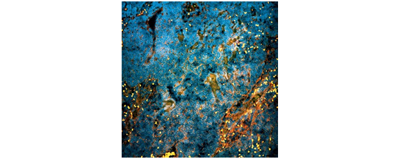 Metastatic Prostate Cancer