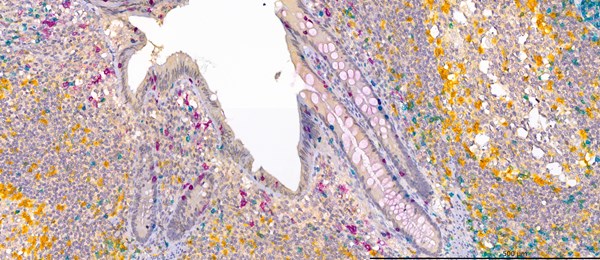 Immunohistochemical staining of paraffin-embedded Human Appendix triple stained for
PD1 (Yellow) - CD8 (Teal) - CD103 (Purple)