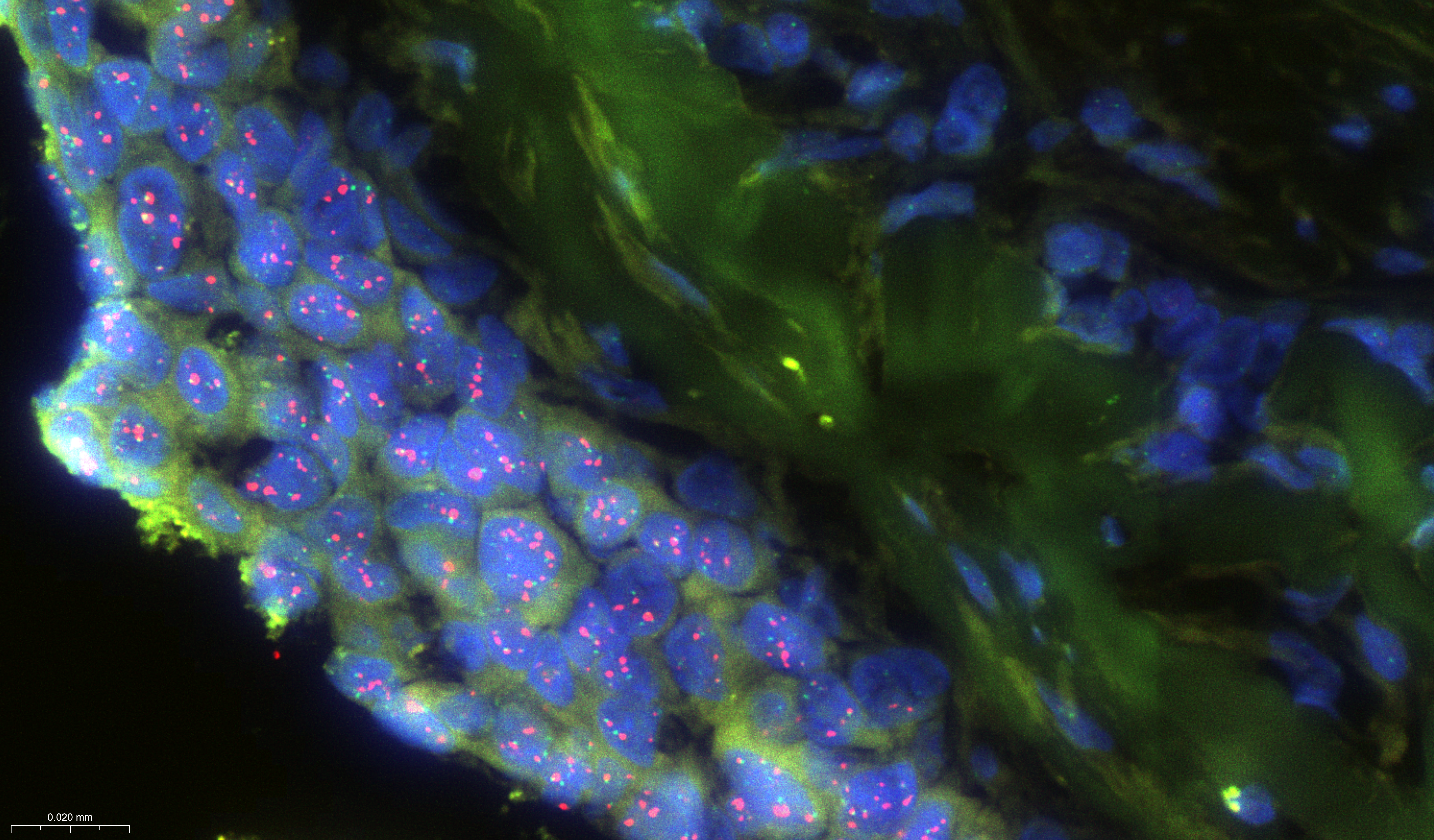 <p class="MsoNormal">DCIS tissue sample with ERBB2 amplified via ecDNA</p>
