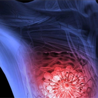 Breast Cancer Square