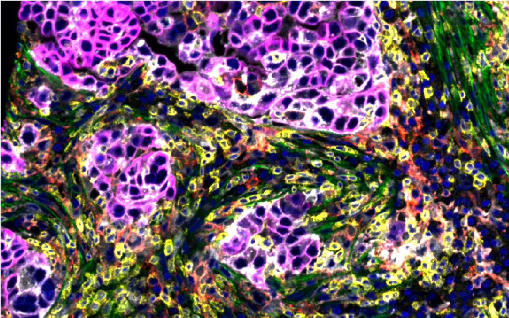 Cancer Discovery Horlings Ea