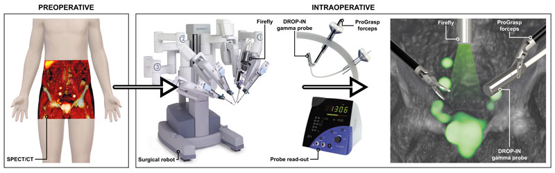 Flexible Lymph Node Detector Successful In Prostate Cancer Patients