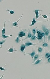 Senescent cancer cells