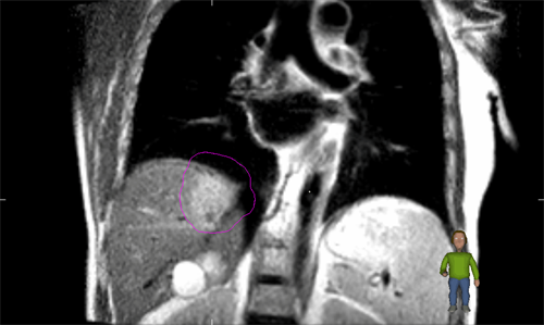 3D MRI
