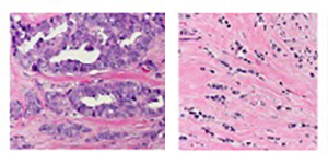Lobular Breast Cancer Pathology2