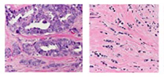 Lobular Breast Cancer Pathology2